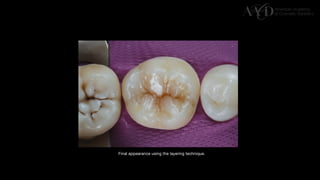 Traditional Layering vs. Modified Bulk Filling