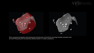 Traditional Layering vs. Modified Bulk Filling