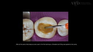 Traditional Layering vs. Modified Bulk Filling