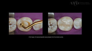 Traditional Layering vs. Modified Bulk Filling