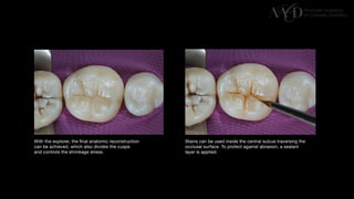 Traditional Layering vs. Modified Bulk Filling