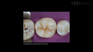 Traditional Layering vs. Modified Bulk Filling