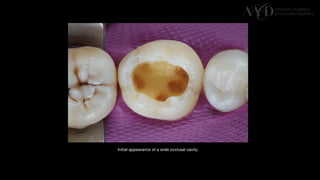 Traditional Layering vs. Modified Bulk Filling