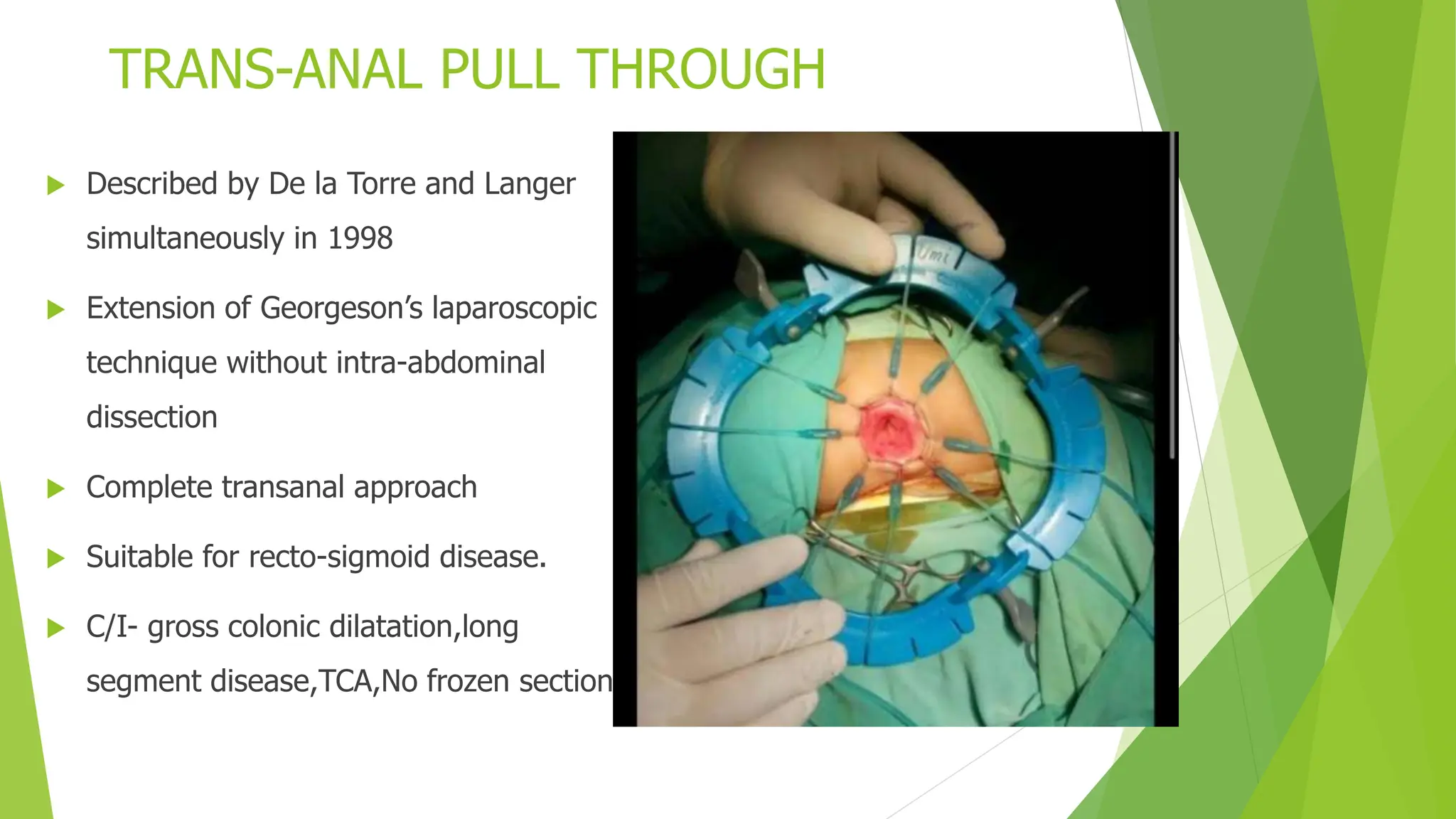 Hirchsprung Disease Is A Congenital Disease PPTX Hirchsprung Disease Is A Congenital Disease PPTX