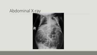 Abdominal X-ray
 