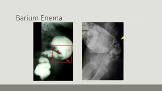 Barium Enema
 