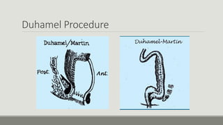 Duhamel Procedure
 