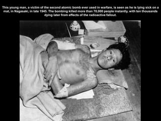 This young man, a victim of the second atomic bomb ever used in warfare, is seen as he is lying sick on a
 mat, in Nagasaki, in late 1945. The bombing killed more than 70,000 people instantly, with ten thousands
                              dying later from effects of the radioactive fallout.
 