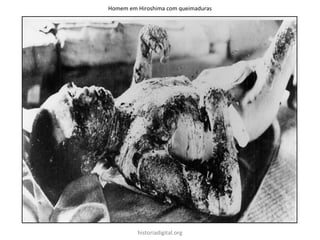 historiadigital.org
Homem em Hiroshima com queimaduras
 