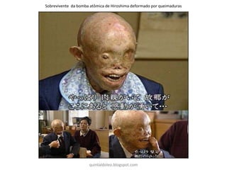 Sobrevivente da bomba atômica de Hiroshima deformado por queimaduras
quintaldoleo.blogspot.com
 