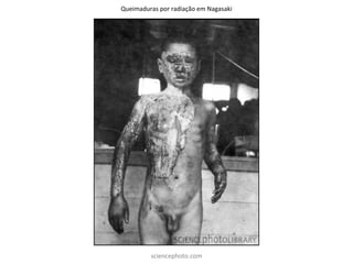 Queimaduras por radiação em Nagasaki
sciencephoto.com
 