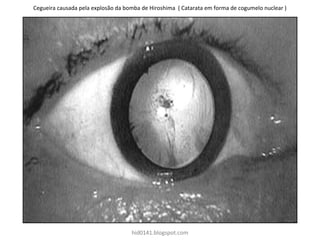 Cegueira causada pela explosão da bomba de Hiroshima ( Catarata em forma de cogumelo nuclear )
hid0141.blogspot.com
 