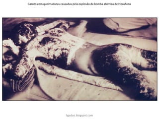 Garoto com queimaduras causadas pela explosão da bomba atômica de Hiroshima
ligadao.blogspot.com
 