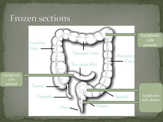 Ganglionic
cells
present
Ganglionic
cells absent
Ganglionic
cells
present
 