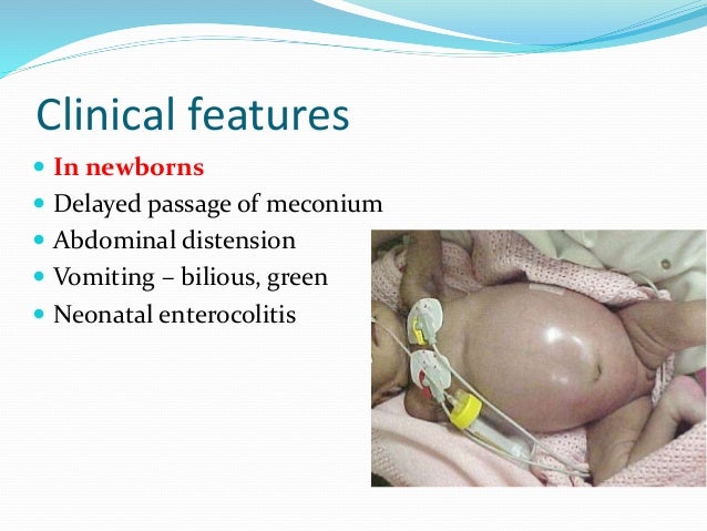 Hirschprung's disease