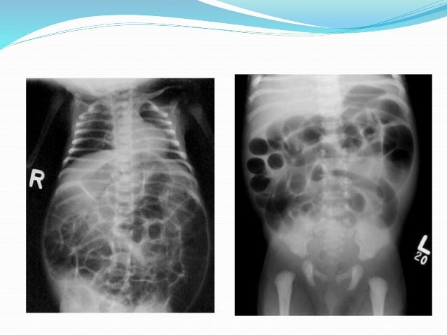 Hirschprung's disease