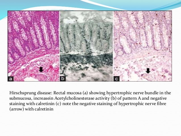 Hirschprung's disease