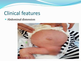 Clinical features
 Abdominal distension
 