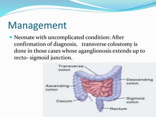 Management
 Neonate with uncomplicated condition: After
confirmation of diagnosis, transverse colostomy is
done in those cases whose aganglionosis extends up to
recto- sigmoid junction.
 