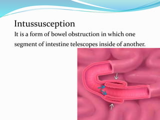 Intussusception
It is a form of bowel obstruction in which one
segment of intestine telescopes inside of another.
 