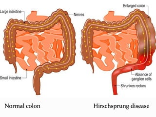 Normal colon Hirschsprung disease
 