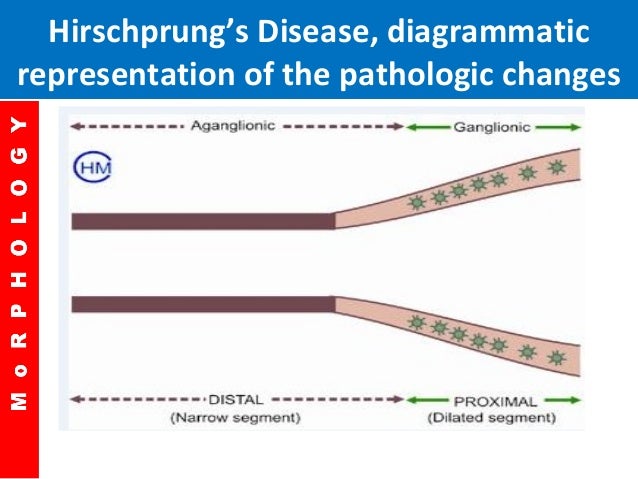 Hirschprung disease by dr manzoor