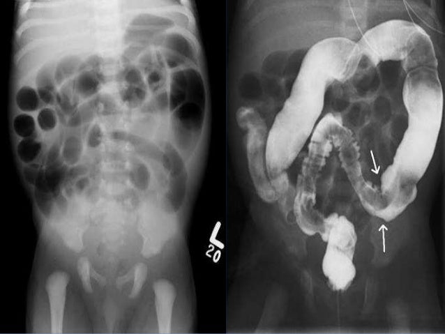 Hirschprung"s disease