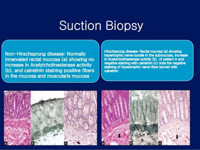 Hirschprung"s disease