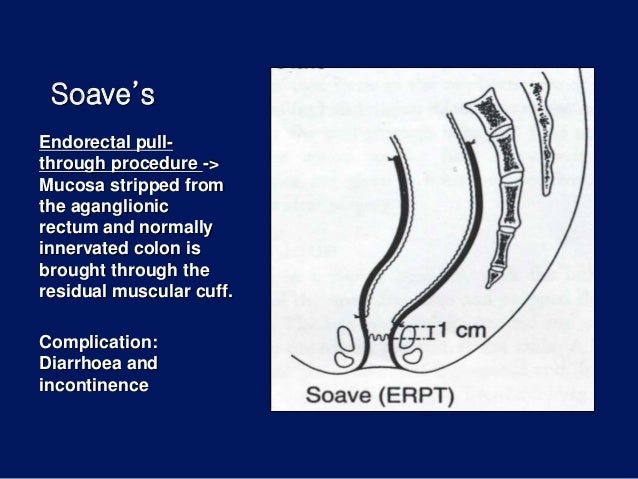 Hirschprung"s disease