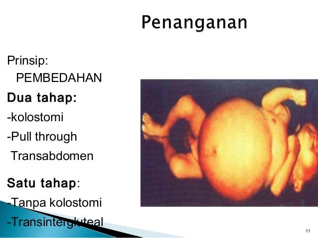 Hirschprung's disease