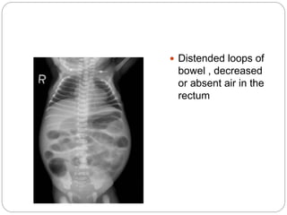  Distended loops of
bowel , decreased
or absent air in the
rectum
 