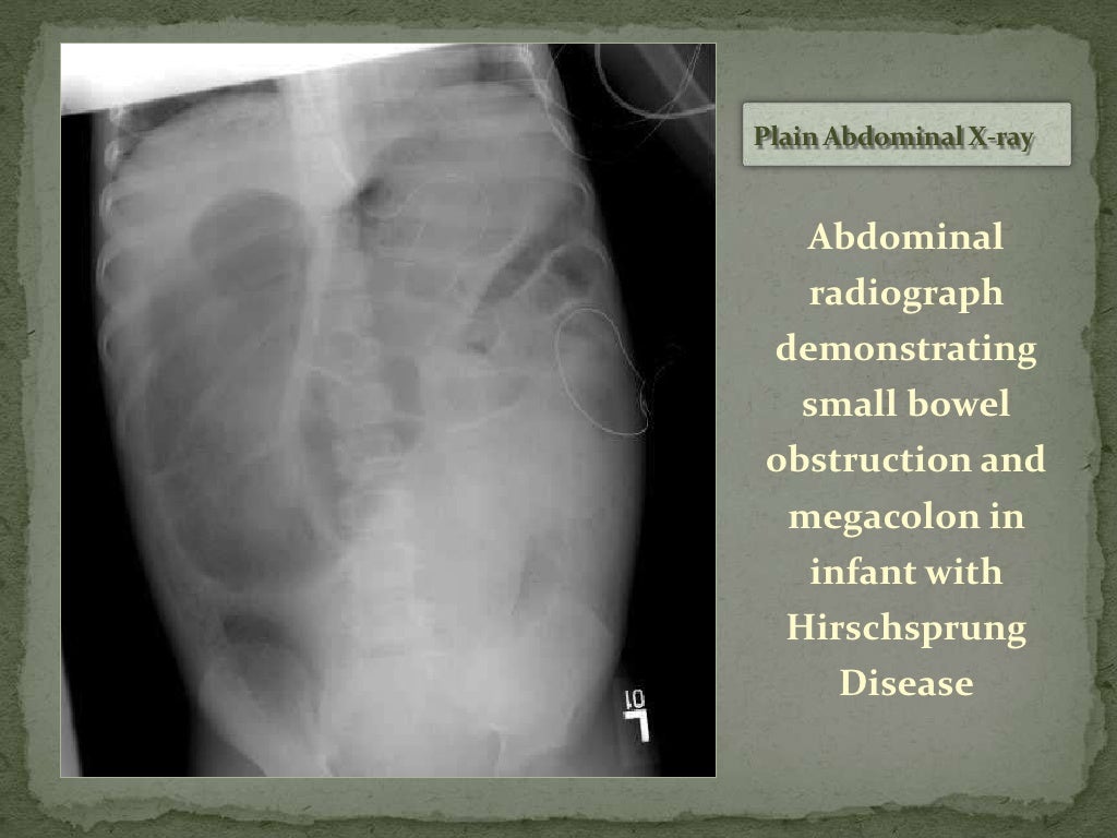 Hirschsprung Disease