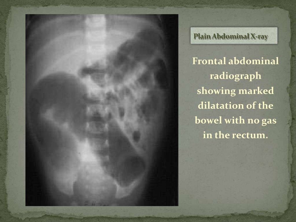Hirschsprung Disease