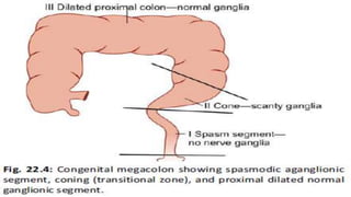  A transition zone exist betweeen dilated,
proximal,normally innervated bowel and the
narrow, distal aganglionic segment
 
