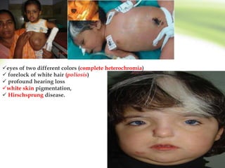 eyes of two different colors (complete heterochromia)
 forelock of white hair (poliosis)
 profound hearing loss
white skin pigmentation,
 Hirschsprung disease.
 