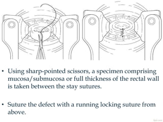 • Using sharp-pointed scissors, a specimen comprising
mucosa/submucosa or full thickness of the rectal wall
is taken between the stay sutures.
• Suture the defect with a running locking suture from
above.
 