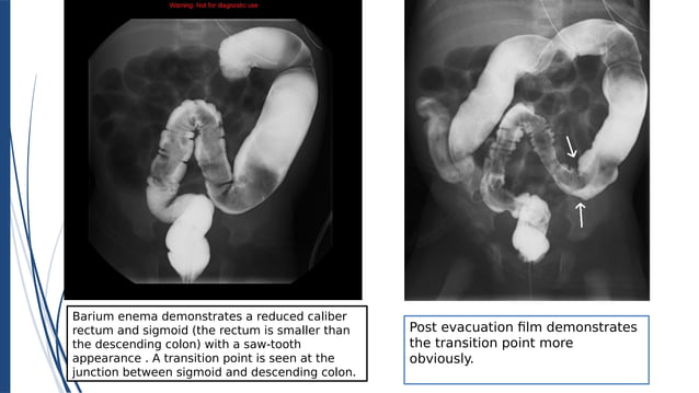 Hirschsprung Disease - Approach & Management | PDF | Digestive ...