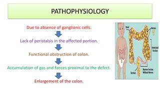 PATHOPHYSIOLOGY
Due to absence of ganglionic cells.
Lack of peristalsis in the affected portion.
Functional obstruction of colon.
Accumulation of gas and faeces proximal to the defect.
Enlargement of the colon.
 