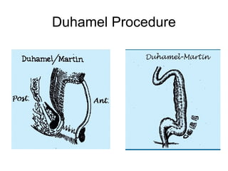 Duhamel Procedure
 
