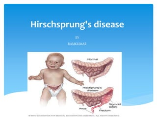 Hirschsprung's disease
BY
RAMKUMAR
 