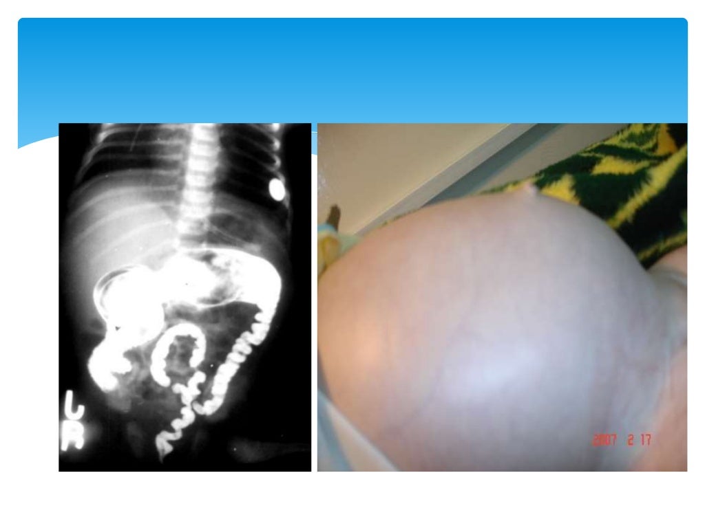 Hirschsprung's disease