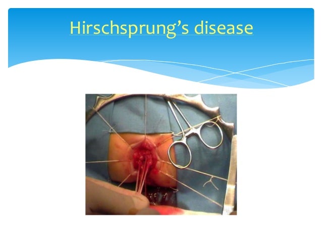 Hirschsprung's disease
