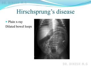 Hirschsprung’s disease
 Plain x-ray
Dilated bowel loops
 