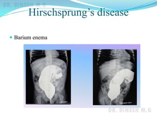 Hirschsprung’s disease
 Barium enema
 