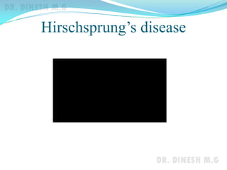 Hirschsprung’s disease
 