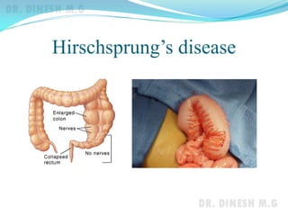 Hirschsprung’s disease
 