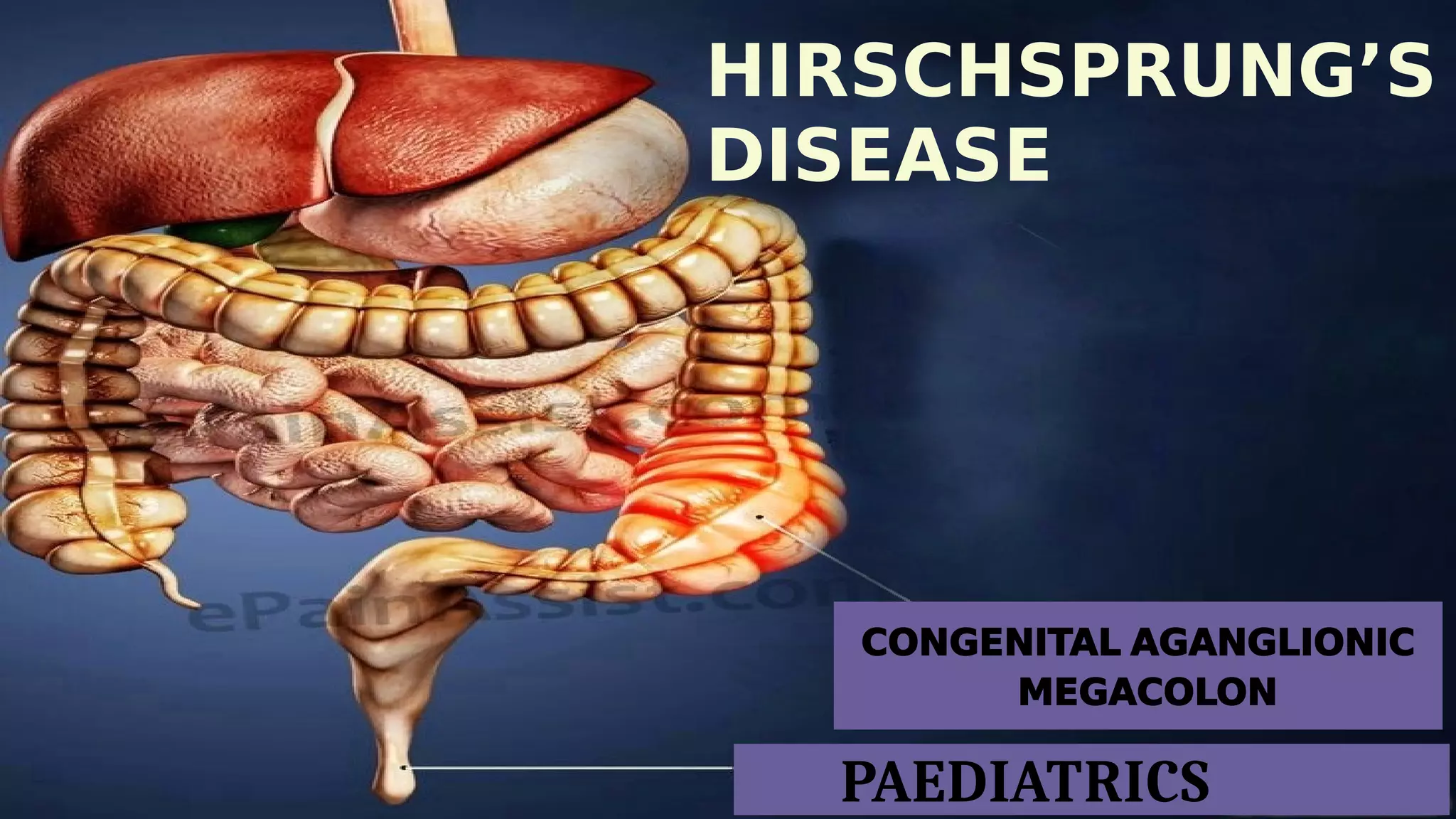 Hirschsprung's diseasedelayed pssage of meconium ,abdominal distension