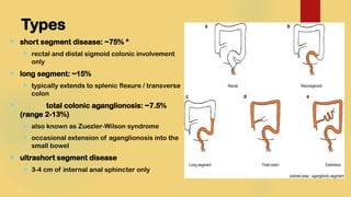 Long Segment surgery - of Hirschsprung’s Disease.pptx