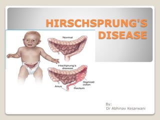 HIRSCHSPRUNG'S
DISEASE
By:
Dr Abhinav Kesarwani
 