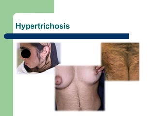 Hypertrichosis